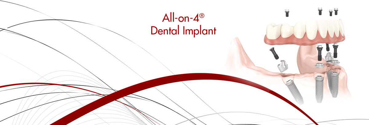 Campbell All-on-4 Dental Implants
