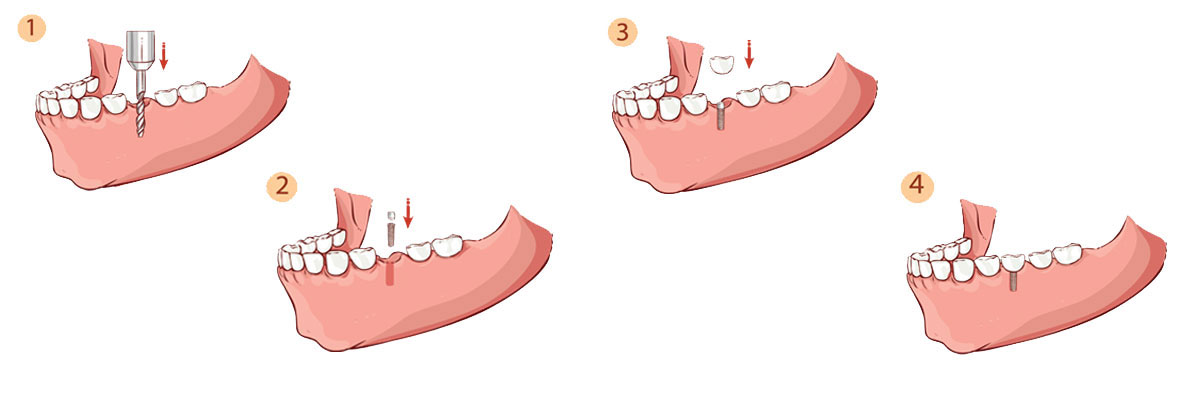 Campbell Dental Implant Restoration